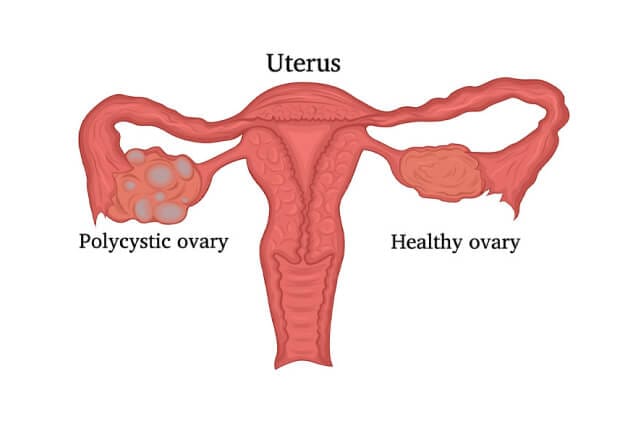 Pcos